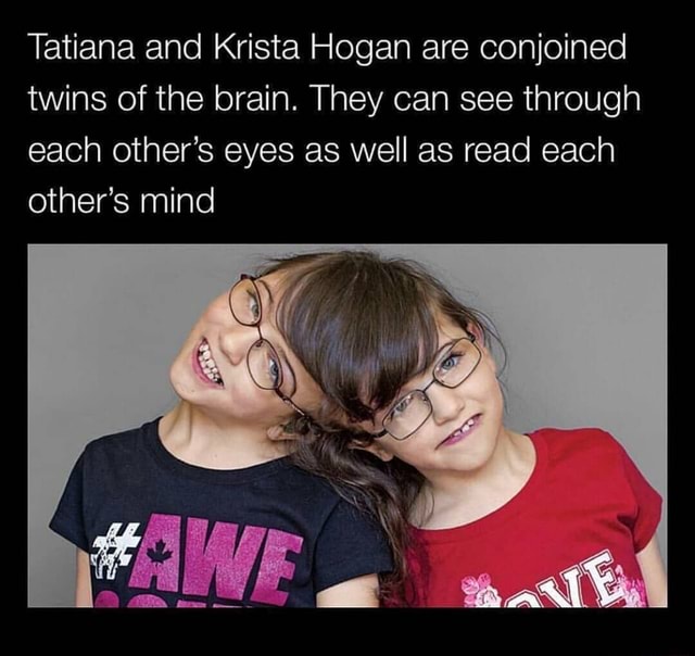 Tatiana And Krista Hogan Are Conjoined Twins Of The Brain They Can See