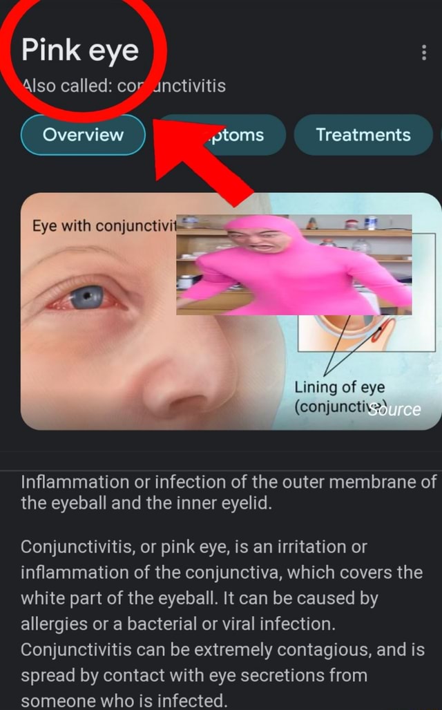 Pink Eye Also Called Cor Unctivitis Eye With Conjunctivi Overview