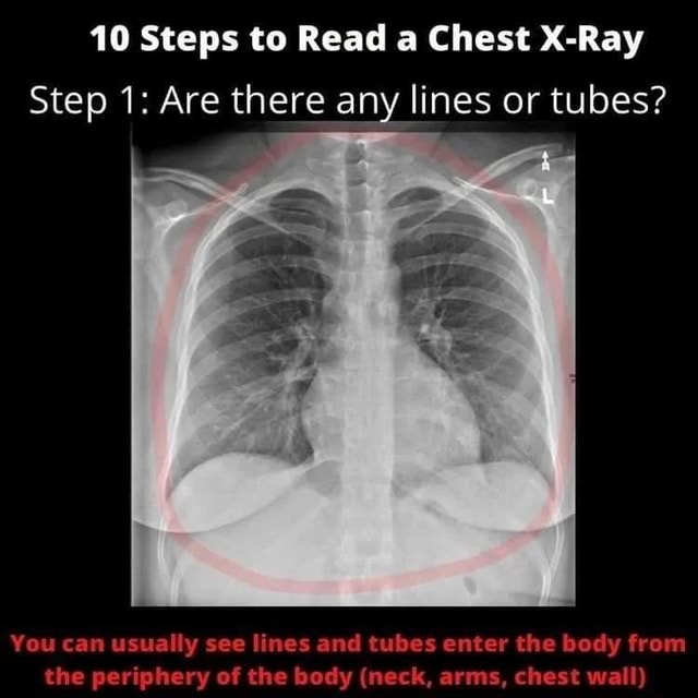 Learn How To Read A Chest X Ray In Steps Follow Radiology For