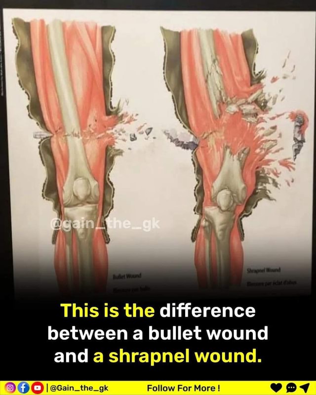 This Is The Difference Between A Bullet Wound And A Shrapnel Wound Fa