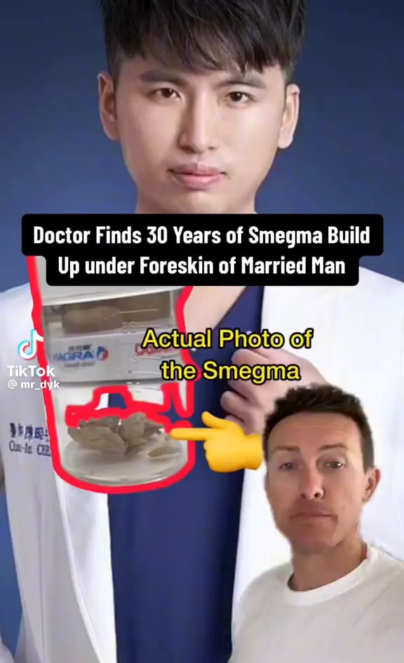 Doctor Finds Years Of Smegma Build Up Under Foreskin Of Married Man