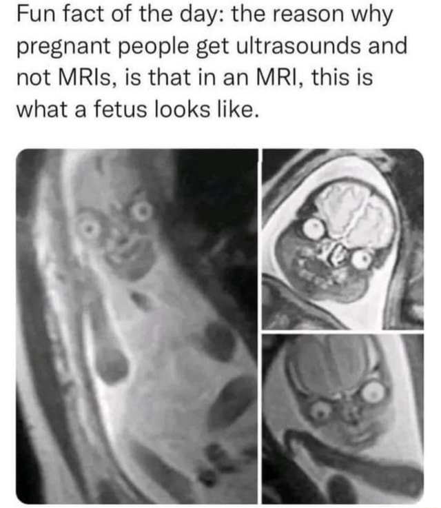 Fun Fact Of The Day The Reason Why Pregnant People Get Ultrasounds And