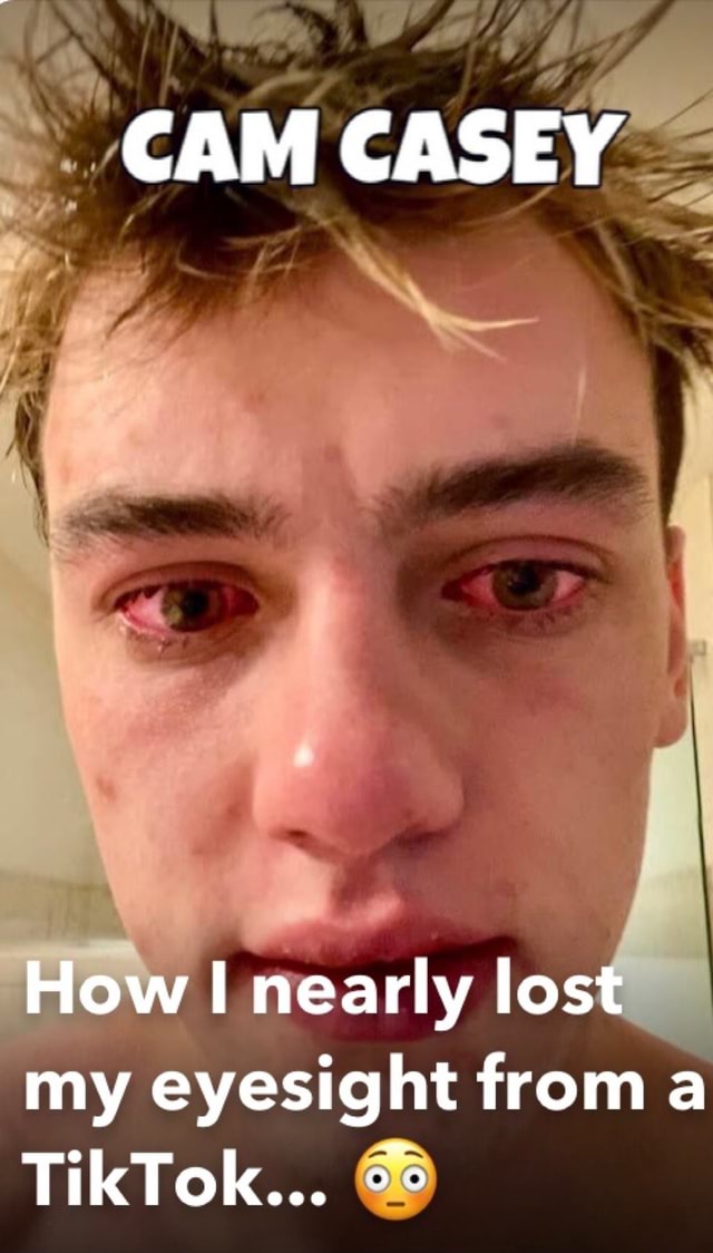 CAM CASEY How nearly lost my eyesight from a TikTok... iFunny