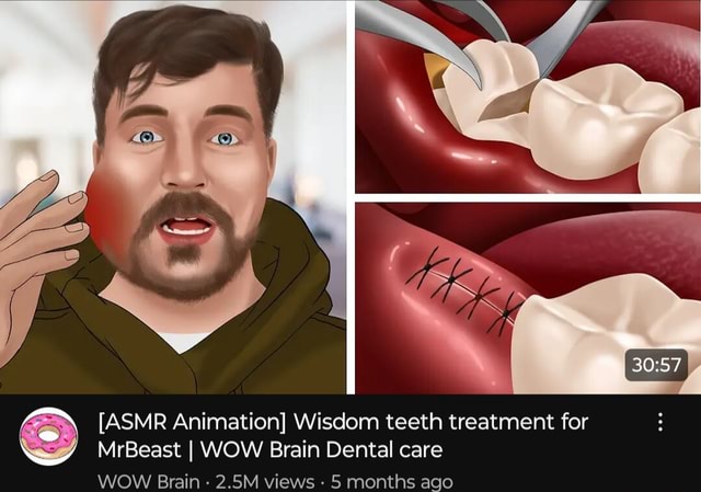 [ASMR Animation] Wisdom teeth treatment for MrBeast I WOW Brain Dental ...
