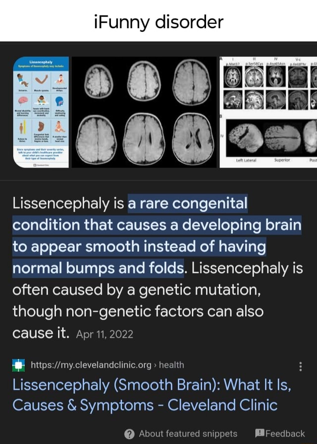 IFunny disorder Lissencephaly is a rare congenital condition that ...