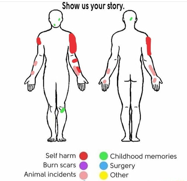 Show Us Your Story Self Harm G Childhood Memories Burn Scars Surgery Animal Incidents Other