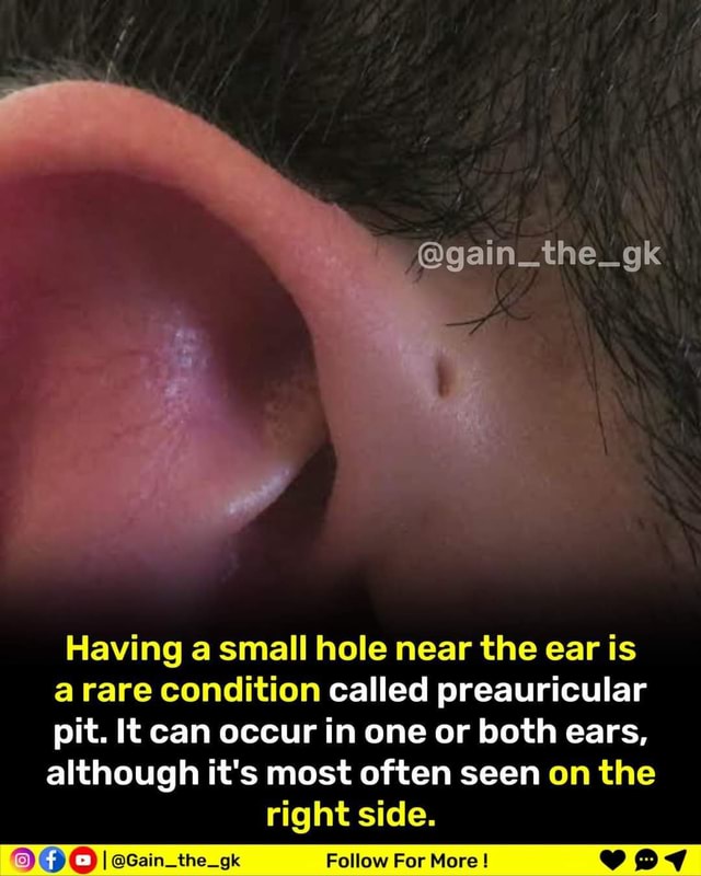 Having a small hole near the ear is a rare condition called ...