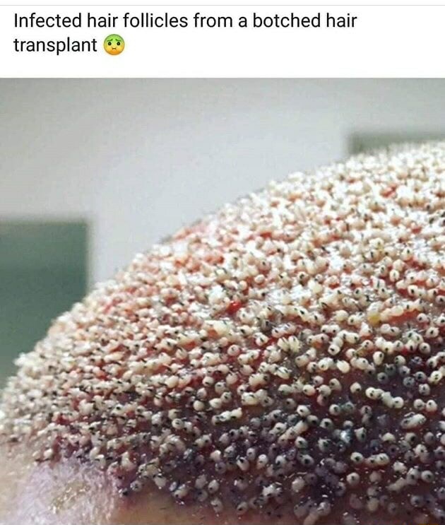 infected-hair-follicles-from-a-botched-hair-transplant-ifunny