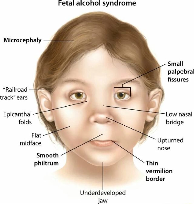 Fetal alcohol syndrome Microcephaly Small palpebral fissures 