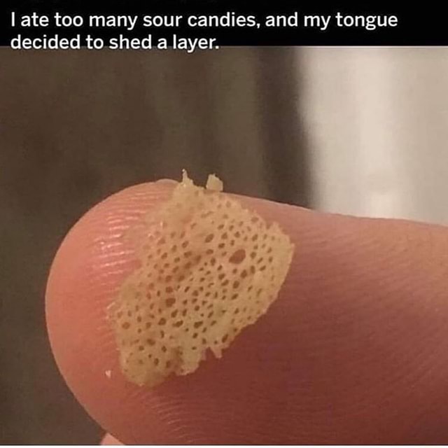 Soothe the Fire – A Comprehensive Guide to Healing a Burnt Tongue from Sour Candy