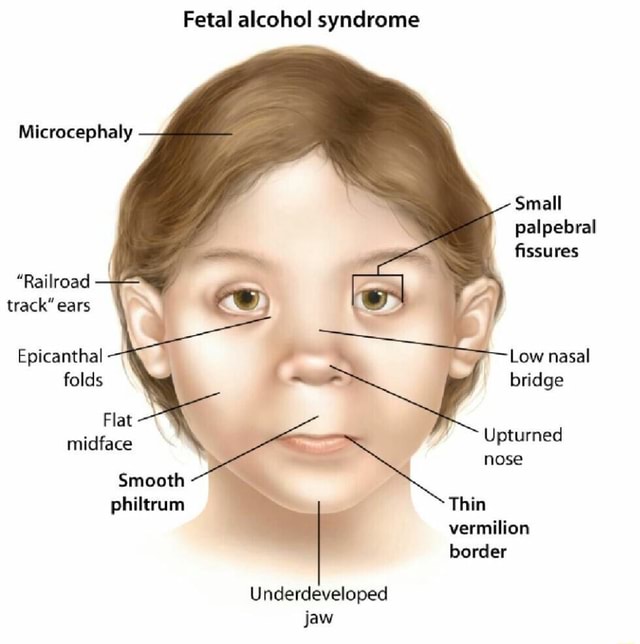 Fetal Alcohol Syndrome Microcephaly Small Palpebral Fissures Railroad Track Ears Epicanthal Low Nasal Folds Bridge Flat Midface Upturned Nose Smooth Philtrum Thin Vermilion Border Underdeveloped Jaw Ifunny