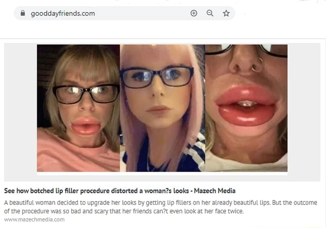 @ @aQr* 'See how botched lip filler procedure distorted a looks ...