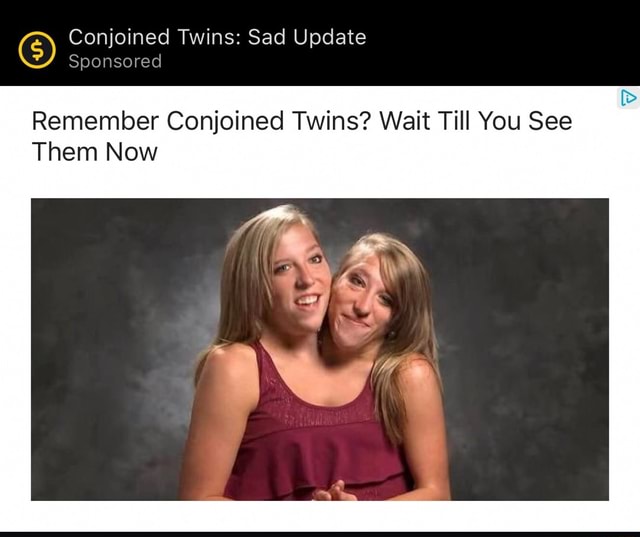 conjoined-twins-sad-update-sponsored-remember-conjoined-twins-wait