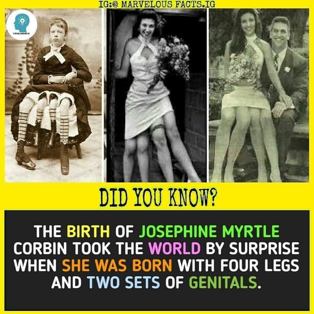Did You Know The Birth Of Josephine Myrtle Corbin Took The World By Surprise When She Was Born With Four Legs And Two Sets Of Genitals America S Best Pics And Videos