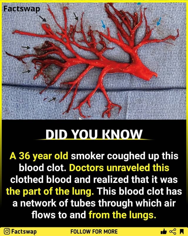 DID YOU KNOW A 36 year old smoker coughed up this blood clot. Doctors