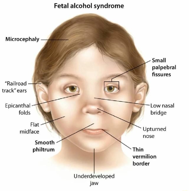 Fetal alcohol syndrome Microcephaly Small palpebral fissures 