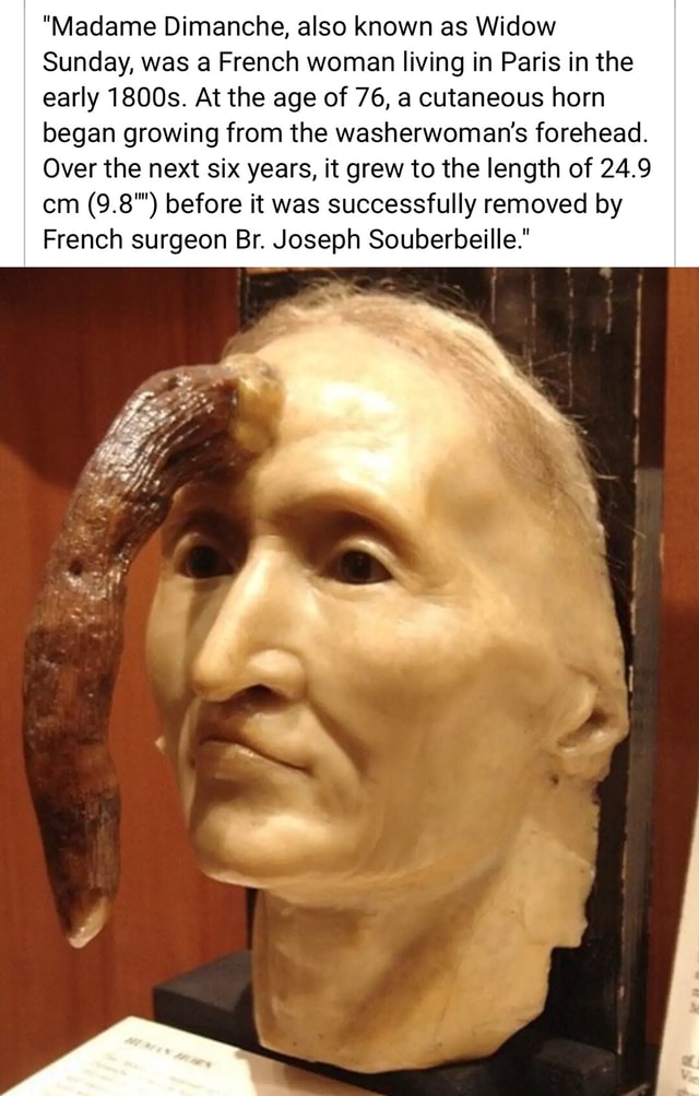 Madame Dimanche, also known as Widow Sunday, was a French woman living in  Paris in the early 1800s. At the age of 76, a cutaneous horn began growing  from the washerwoman's forehead.