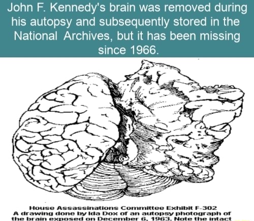 John F. Kennedy's Brain Was Removed During His Autopsy And Subsequently ...