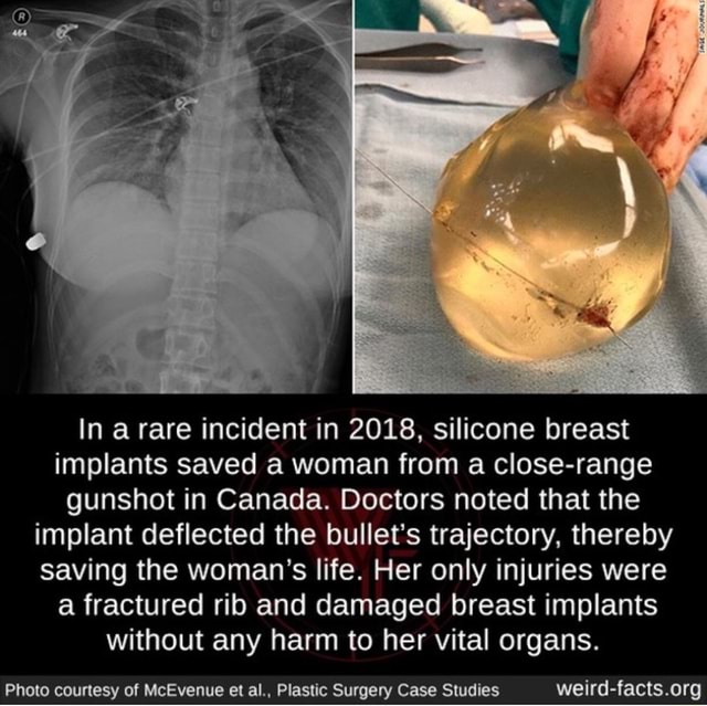 In A Rare Incident In 2018 Silicone Breast Implants Saved A Woman From A Close Range Gunshot In