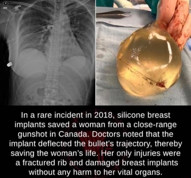 In A Rare Incident In 2018 Silicone Breast Implants Saved A Woman From