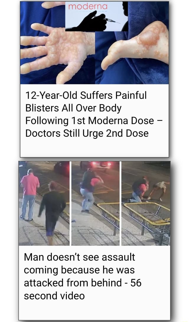 Moderna Old Suffers Painful Blisters All Over Body Following Moderna