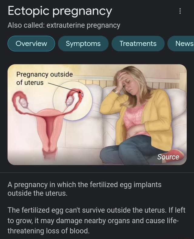 Ectopic pregnancy Also called extrauterine pregnancy ( Overview