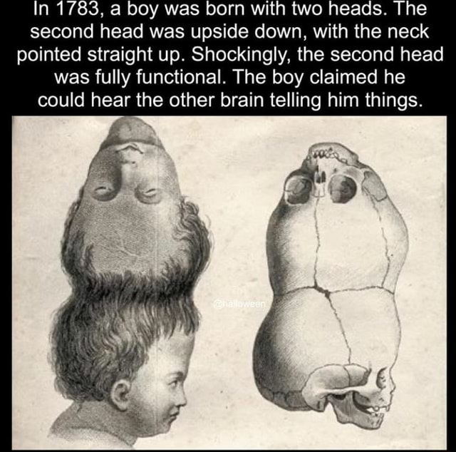 In 1783, a boy was born with two heads. The second head was upside down