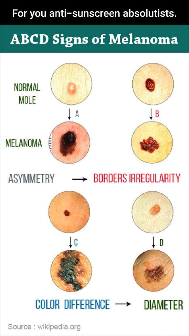 For You Anti-sunscreen Absolutists. Abcd Signs Of Melanoma Normal Mole 