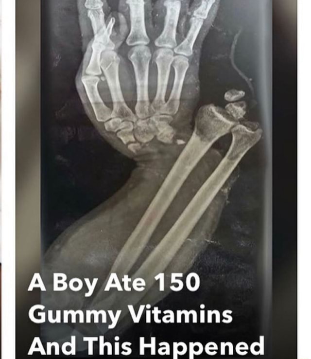 Boy Ate 150 Gummy Vitamins For Breakfast A Boy Ate 150 Gummy Vitamins And This Happened - iFunny