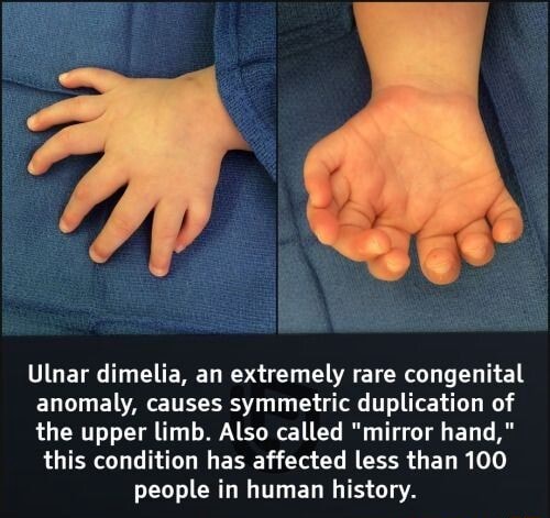Ulnar dimelia, an extremely rare congenital anomaly, causes symmetric ...