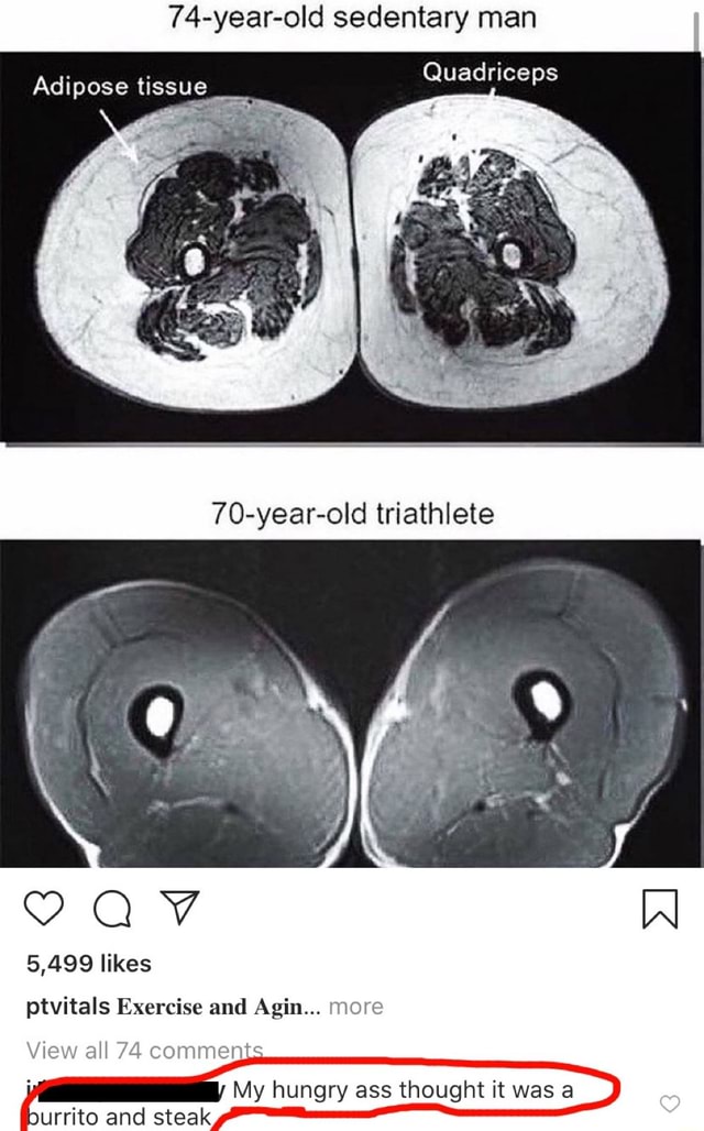 74-year-old-sedentary-man-quadriceps-adipose-tissue-70-year-old