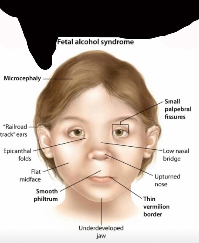 Microcephaly Small palpebral fissures 