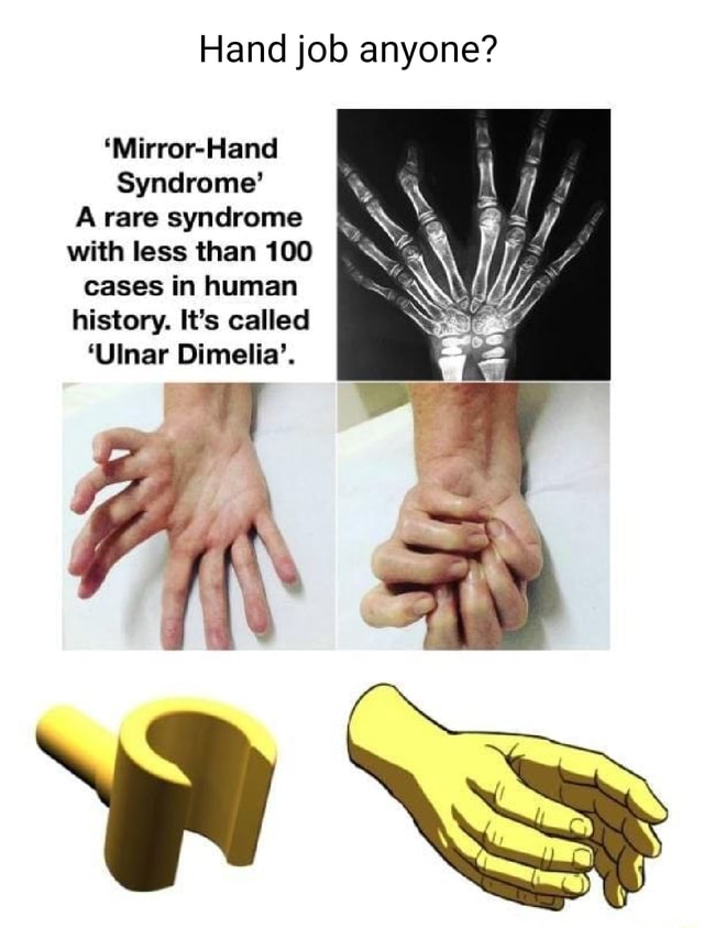Hand job anyone? 'MirrorHand Syndrome' A rare syndrome with less than