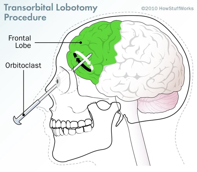 Transorbital Lobotomy Howstuffworks Procedure Frontal Lobe Orbitoclast