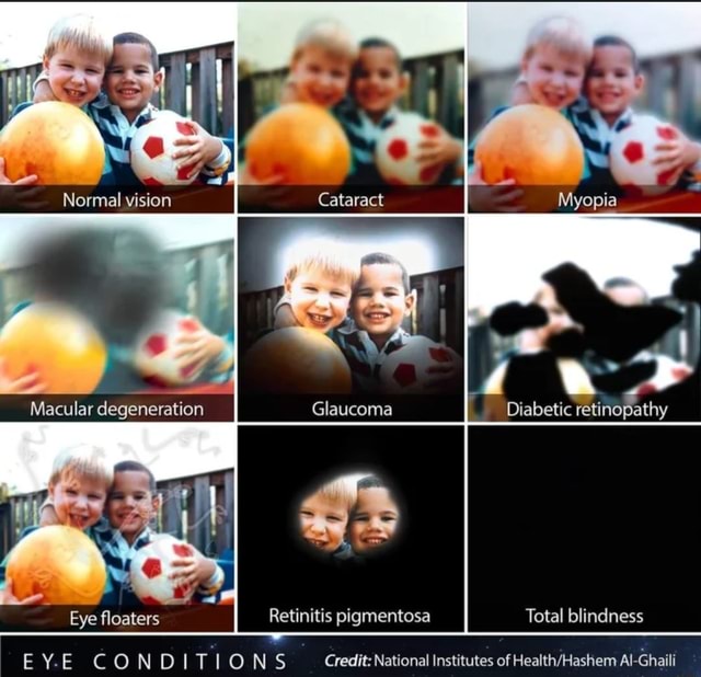 Normal vision Cataract Myopia Macular degeneration Diabetic re