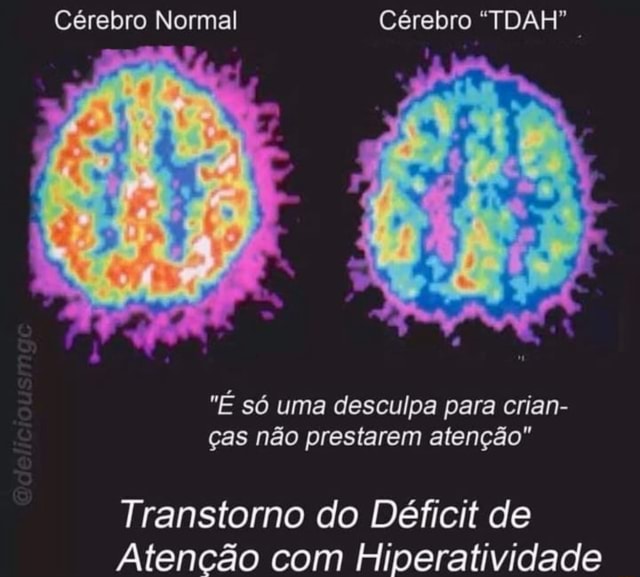 Cérebro Normal Cérebro 