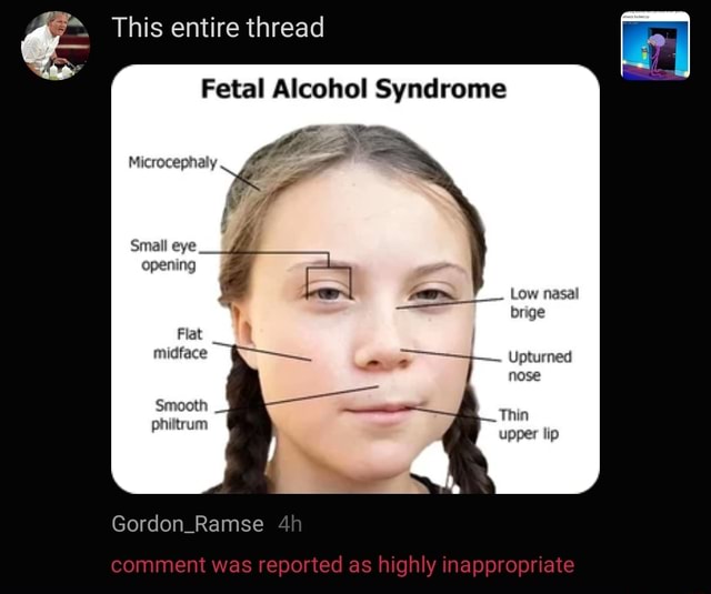 Fetal Alcohol Syndrome Microcephaly a f Small eye opening - iFunny