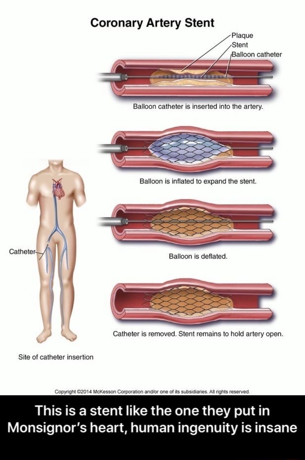 Coronary Artery Stent 'Plaque 'Stent jBalloon catheter tho to the deflated Catheter is removed