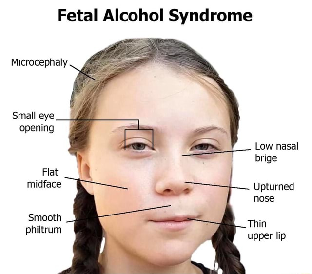 Fetal Alcohol Syndrome Microcephaly Ifunny