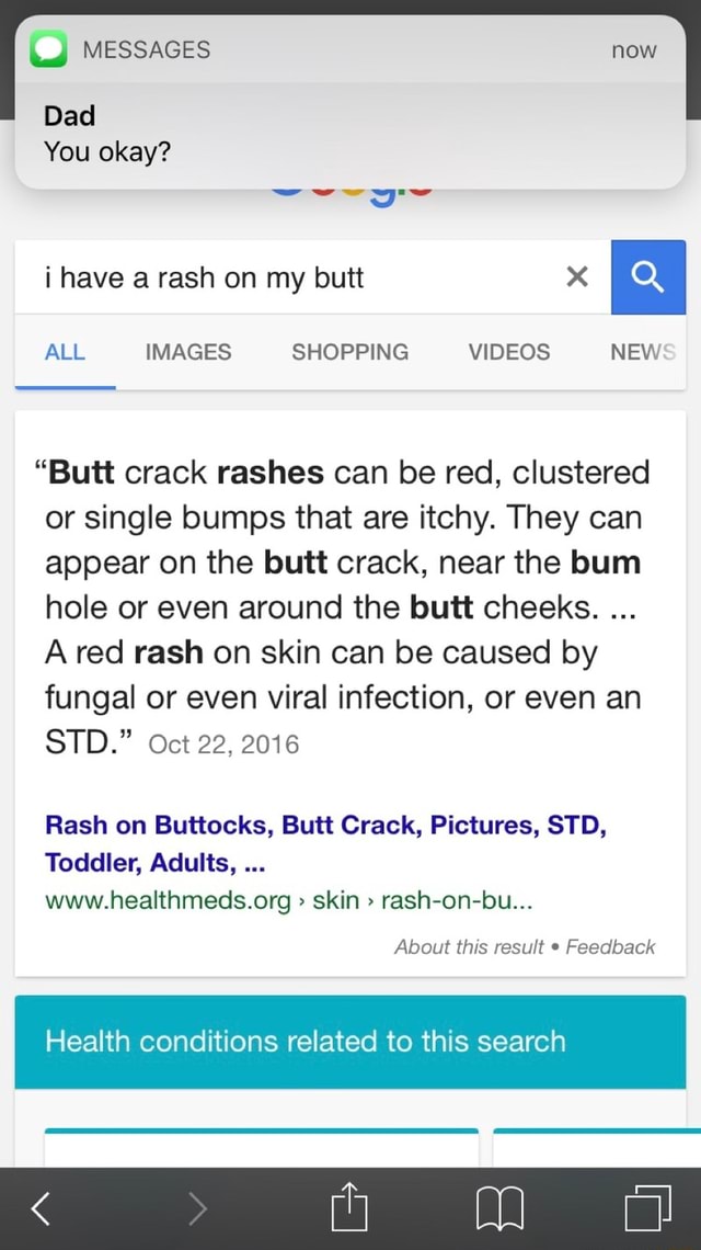 itching rash on buttocks crack