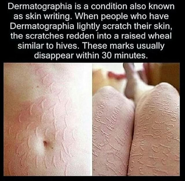 Dermatographia Is A Condition Also Known As Skin Writing When People Who Have Dermatographia