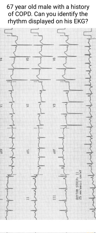 67 year old male with a history of COPD. Can you identify the rhythm ...