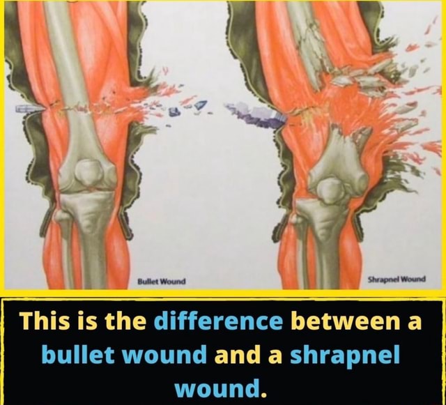 Bullet Wound I This is the difference between a bullet wound and a