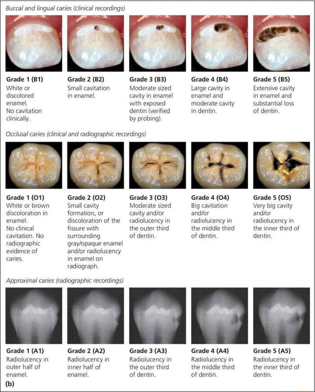 Buccal and lingual caries (clinical recordings) Grade 1 Grade 2 White ...
