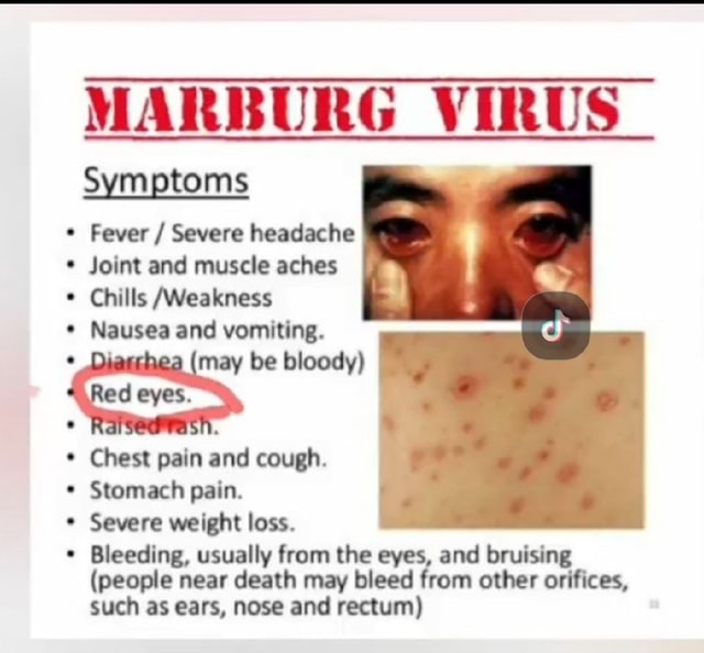 Symptoms MARBURG VIRUS Fever / Severe headache * Joint and muscle aches