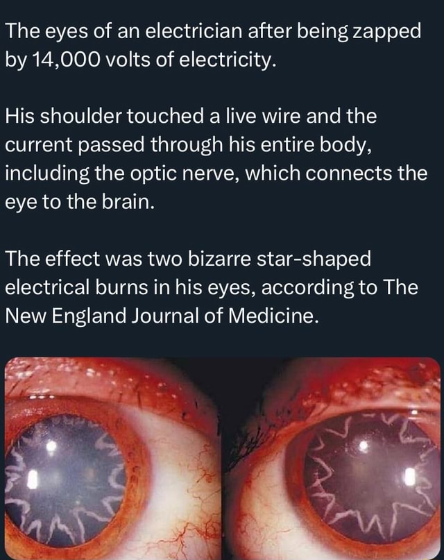 The eyes of an electrician after being zapped by 14,000 volts of