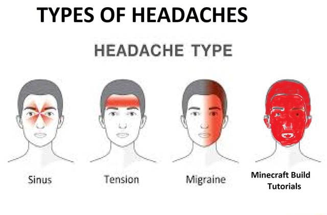 TYPES OF HEADACHES HEADACHE TYPE Sinus Tension Migraine Tutorials ...