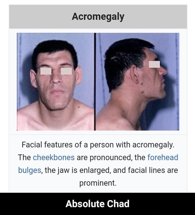 Acromegaly Facial features of a person with acromegaly. The cheekbones ...