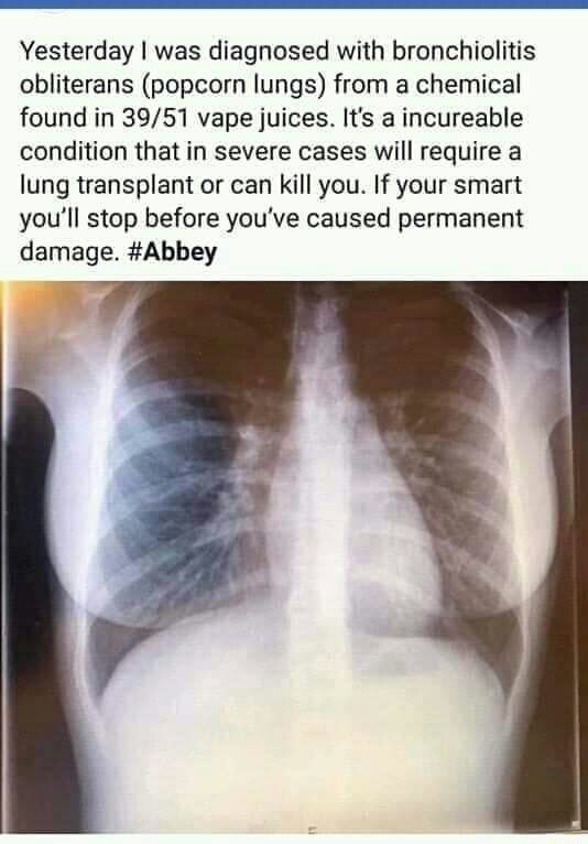 Yesterday] was diagnosed with bronchioliﬁs obliterans (popcorn lungs