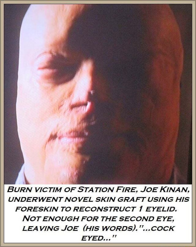 BURN VICTIM OF STATION FIRE, JOE KINAN, UNDERWENT NOVEL SKIN GRAFT